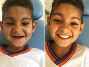 Aos seis anos, menino ganhou prótese e emocionou equipe médica (Foto: Amando Mattos/Arquivo Pessoal)